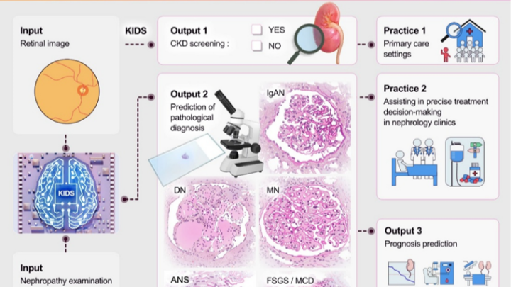 Guangdong doctors develop kidney disease diagnosis system based on retinal images